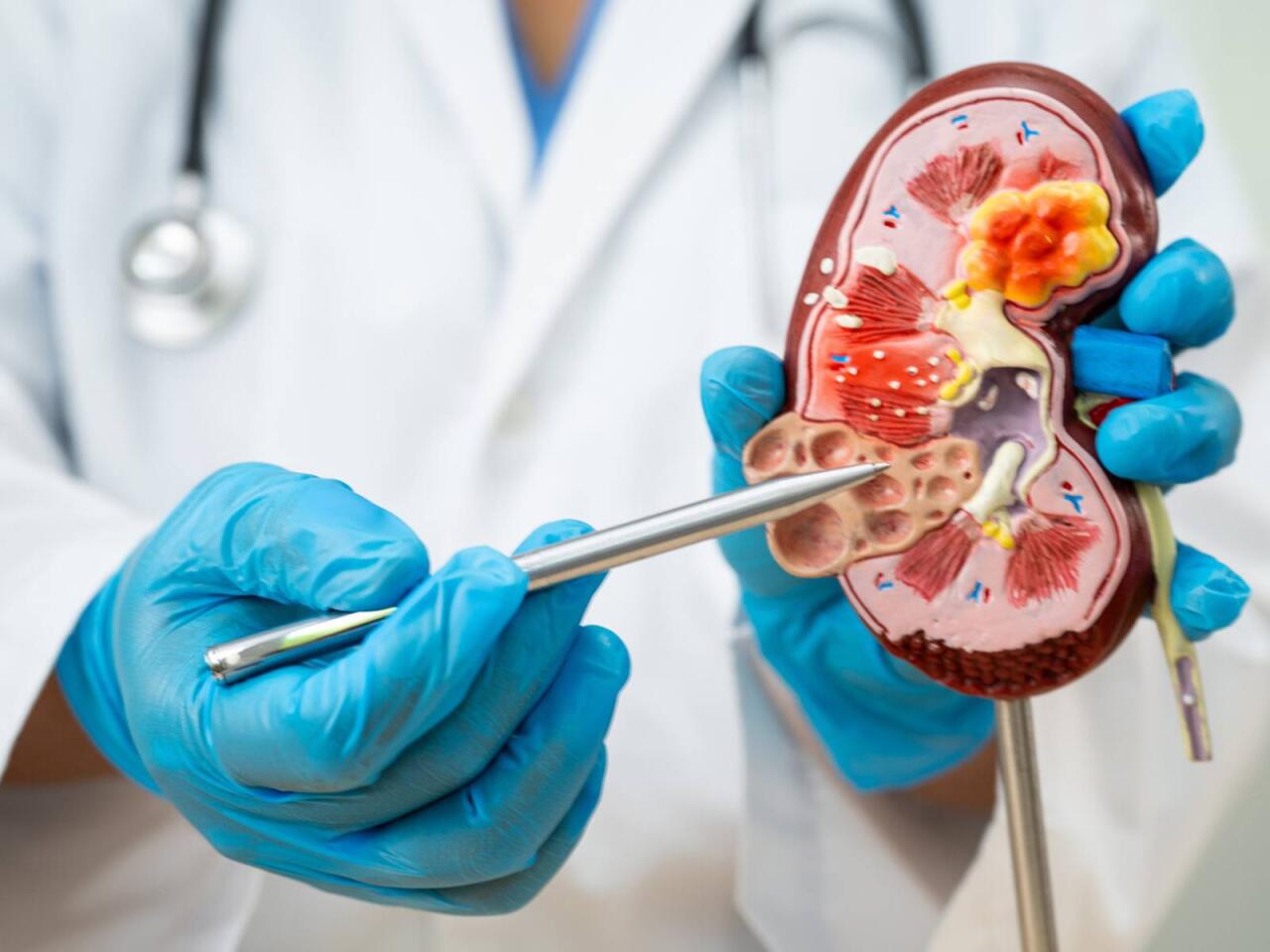 Böyrək daşlarının yaranmasına səbəb olan qidalar açıqlandı