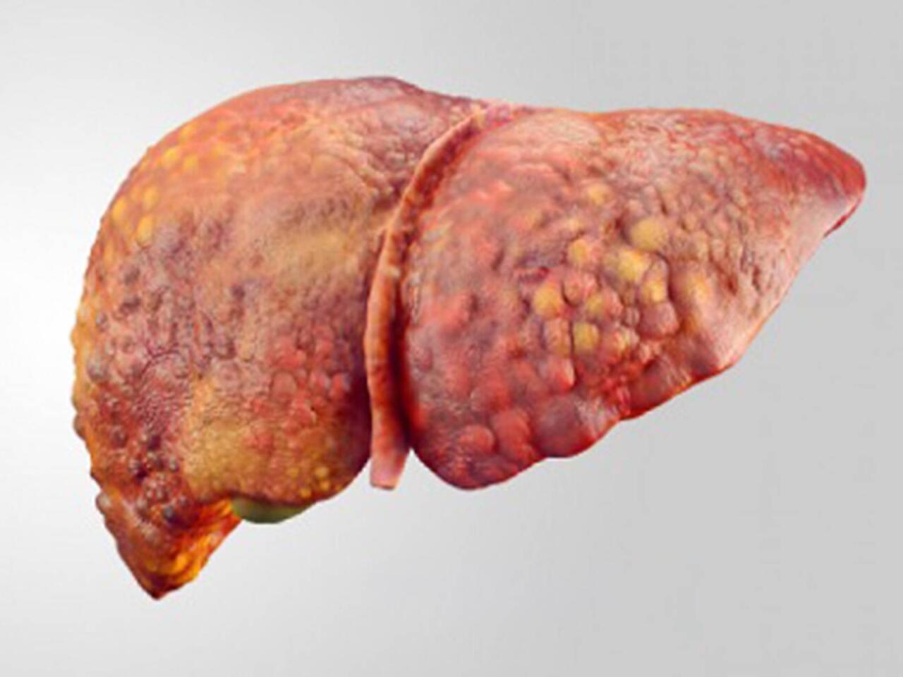 Qaraciyər yağlanıbsa ölüm riski 35 dəfə artır