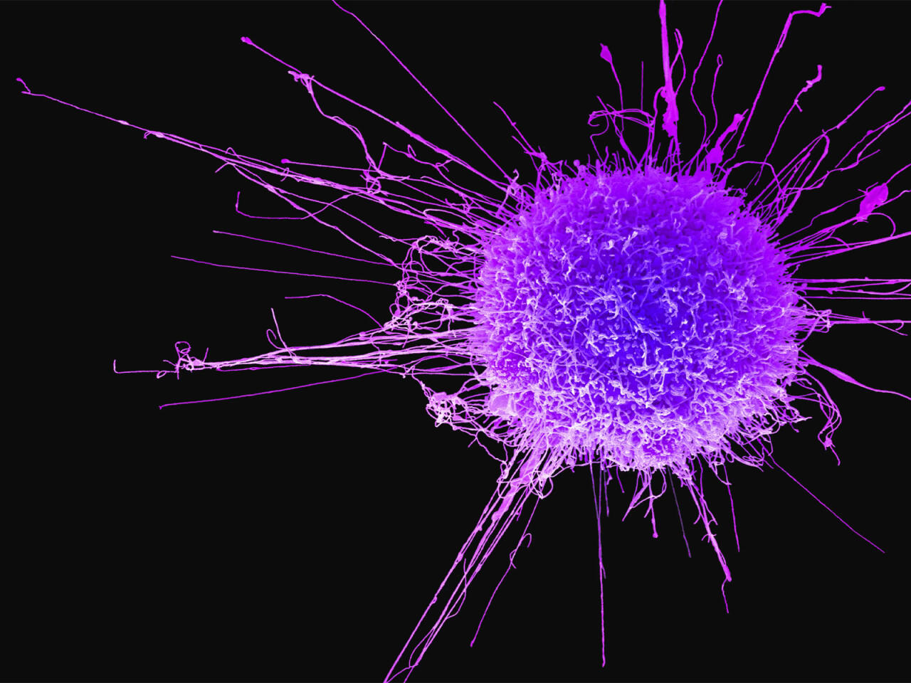 Sümük xərçənginin də çarəsi tapıldı