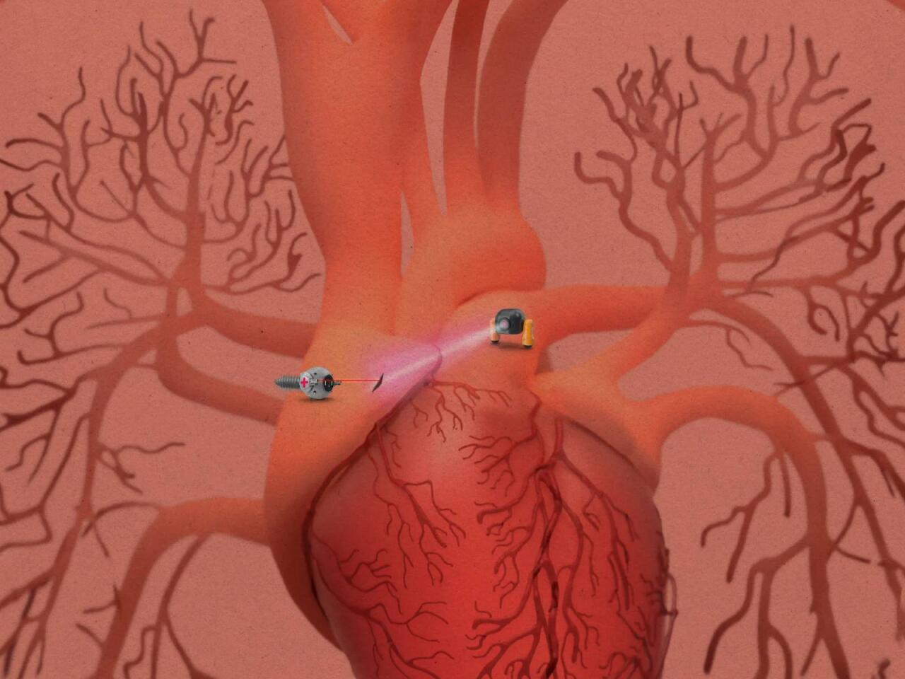 Robot ağrıkəsicilər hazırlandı  Toxumanı tapıb sağaldır, sonra da yox olur