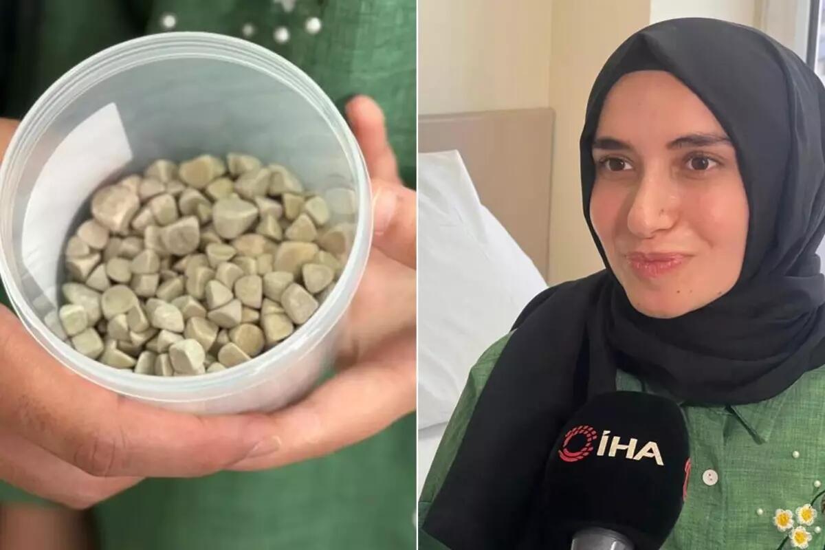 21 yaşlı Fatmanın bədənindən 287 daş çıxarıldı – tibb aləmi şokda 