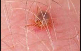 Gənə bu Avropa &ouml;lkəsini cənginə aldı  185 rayon təhl&uuml;kədədir