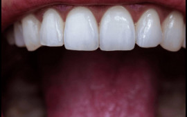 Daimi stresin dişlərə zərərli TƏSİRLƏRİ