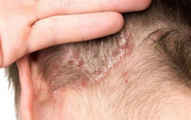 Başdakı sızanaqlar bu problemlərdən xəbər verə bilər