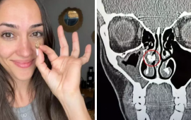 Qadının burnundan görün nə çıxdı  35 ildir belə yaşayıbmış...