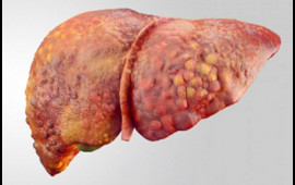 Qaraciyər yağlanıbsa ölüm riski 35 dəfə artır