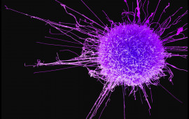 Sümük xərçənginin də çarəsi tapıldı