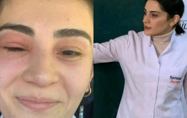 "Tək gözlə imtahandan 55 bal topladım"  Gözünü arı sancan müəllim
