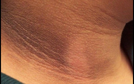 Dibaetin erkən əlamətləri  Dəridə belə izlər yaranır