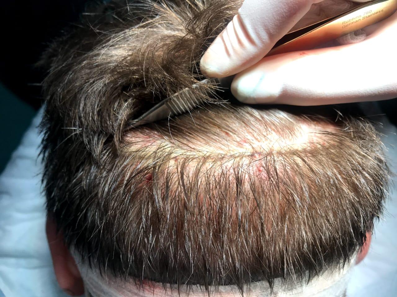 47 yaşlı kişi sa&ccedil; əkimi zamanı &ouml;ld&uuml;