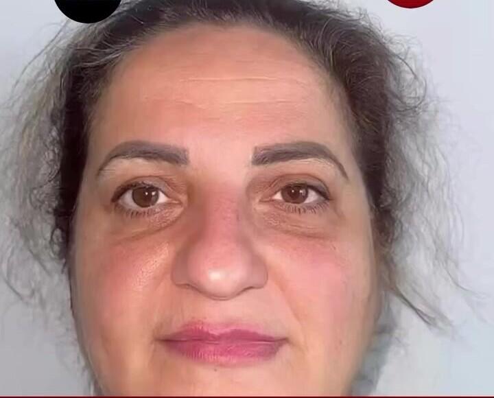 60 yaşlı qadın əməliyyatla 30 yaş CAVANLAŞDI 