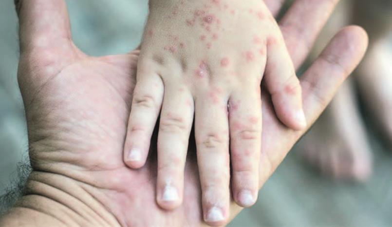 Bakıda uşaq evində azyaşlı qızılcadan &Ouml;LD&Uuml; 