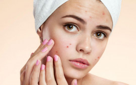 Sızanaqlardan təbii yollarla qurtulmağın effektiv &uuml;sulları